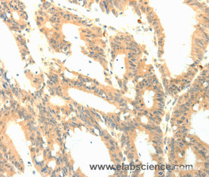 Immunohistochemistry of paraffin-embedded Human colon cancer tissue using P23 Polyclonal Antibody at dilution 1:50