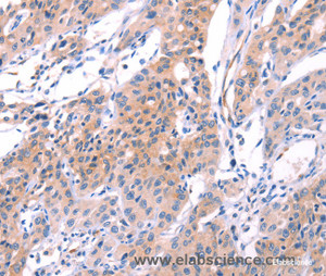 Immunohistochemistry of paraffin-embedded Human lung cancer tissue using VWF Polyclonal Antibody at dilution 1:50