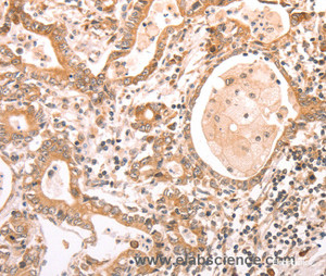 Immunohistochemistry of paraffin-embedded Human gasrtic cancer tissue using ABCF1 Polyclonal Antibody at dilution 1:40