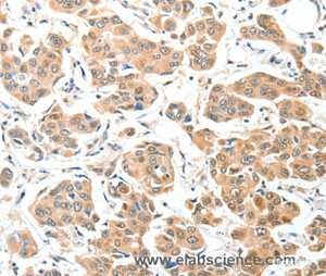 Immunohistochemistry of paraffin-embedded Human breast cancer tissue using ADCK1 Polyclonal Antibody at dilution 1:40