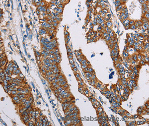 Immunohistochemistry of paraffin-embedded Human gasrtic cancer tissue using ALG2 Polyclonal Antibody at dilution 1:35