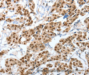 Immunohistochemistry of paraffin-embedded Human breast cancer tissue using ANXA10 Polyclonal Antibody at dilution 1:35