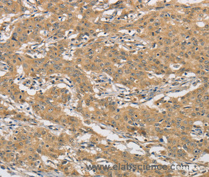 Immunohistochemistry of paraffin-embedded Human gasrtic cancer tissue using AMZ2 Polyclonal Antibody at dilution 1:60
