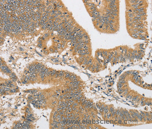 Immunohistochemistry of paraffin-embedded Human colon cancer tissue using ARHGAP15 Polyclonal Antibody at dilution 1:30