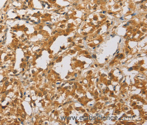 Immunohistochemistry of paraffin-embedded Human thyroid cancer tissue using ARHGEF5 Polyclonal Antibody at dilution 1:40