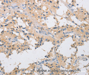 Immunohistochemistry of paraffin-embedded Human thyroid cancer tissue using IKK gamma Polyclonal Antibody at dilution 1:40