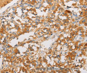 Immunohistochemistry of paraffin-embedded Human thyroid cancer tissue using ART3 Polyclonal Antibody at dilution 1:40