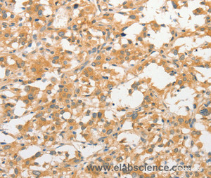 Immunohistochemistry of paraffin-embedded Human thyroid cancer tissue using TLR3 Polyclonal Antibody at dilution 1:40