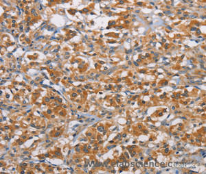 Immunohistochemistry of paraffin-embedded Human thyroid cancer tissue using RICTOR Polyclonal Antibody at dilution 1:40