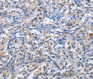 Immunohistochemistry of paraffin-embedded Human thyroid cancer tissue using PIM1 Polyclonal Antibody at dilution 1:50