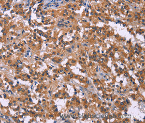 Immunohistochemistry of paraffin-embedded Human thyroid cancer tissue using PIP5K1B Polyclonal Antibody at dilution 1:30