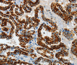 Immunohistochemistry of paraffin-embedded Human thyroid cancer tissue using ASB4 Polyclonal Antibody at dilution 1:40