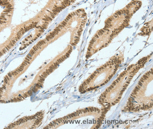 Immunohistochemistry of paraffin-embedded Human colon cancer tissue using ASH2L Polyclonal Antibody at dilution 1:50