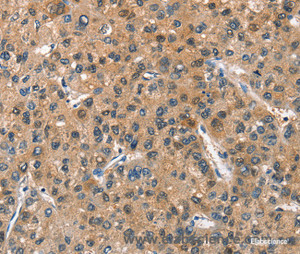 Immunohistochemistry of paraffin-embedded Human liver cancer tissue using ASB2 Polyclonal Antibody at dilution 1:40