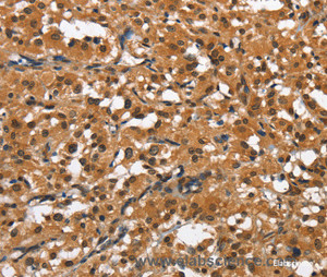 Immunohistochemistry of paraffin-embedded Human thyroid cancer tissue using SLAMF8 Polyclonal Antibody at dilution 1:50