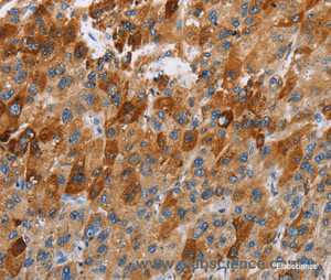 Immunohistochemistry of paraffin-embedded Human liver cancer tissue using CCR9 Polyclonal Antibody at dilution 1:40