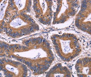 Immunohistochemistry of paraffin-embedded Human colon cancer tissue using KIR2DL1/3/4/S4 Polyclonal Antibody at dilution 1:40