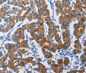 Immunohistochemistry of paraffin-embedded Human breast cancer tissue using NCR3 Polyclonal Antibody at dilution 1:40