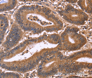 Immunohistochemistry of paraffin-embedded Human colon cancer tissue using CDC37L1 Polyclonal Antibody at dilution 1:50