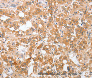 Immunohistochemistry of paraffin-embedded Human thyroid cancer tissue using cPLA2 Polyclonal Antibody at dilution 1:40