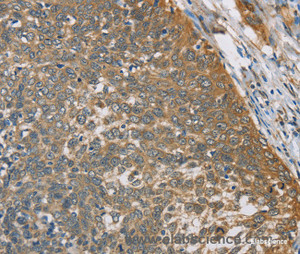 Immunohistochemistry of paraffin-embedded Human cervical cancer tissue using TNFRSF10D Polyclonal Antibody at dilution 1:40