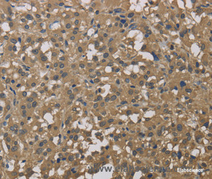 Immunohistochemistry of paraffin-embedded Human thyroid cancer tissue using DCTN3 Polyclonal Antibody at dilution 1:50