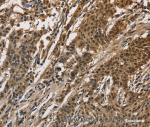 Immunohistochemistry of paraffin-embedded Human gasrtic cancer tissue using CCAR1 Polyclonal Antibody at dilution 1:40