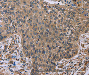 Immunohistochemistry of paraffin-embedded Human lung cancer tissue using EDA Polyclonal Antibody at dilution 1:50