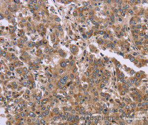 Immunohistochemistry of paraffin-embedded Human liver cancer tissue using FAM3B Polyclonal Antibody at dilution 1:30