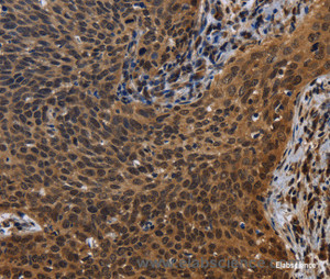 Immunohistochemistry of paraffin-embedded Human cervical cancer tissue using FHL3 Polyclonal Antibody at dilution 1:40