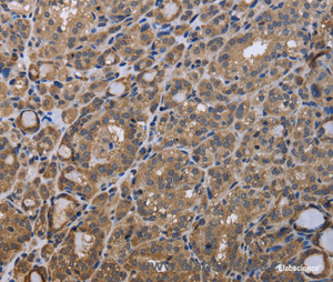 Immunohistochemistry of paraffin-embedded Human thyroid cancer tissue using GADD45B Polyclonal Antibody at dilution 1:40