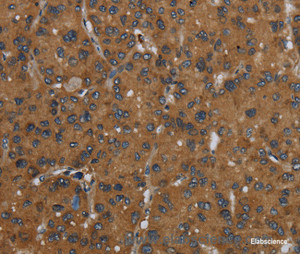 Immunohistochemistry of paraffin-embedded Human liver cancer tissue using ID2 Polyclonal Antibody at dilution 1:30