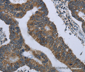 Immunohistochemistry of paraffin-embedded Human colon cancer tissue using CD236 Polyclonal Antibody at dilution 1:60