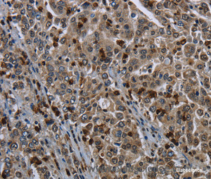 Immunohistochemistry of paraffin-embedded Human liver cancer tissue using CD42b Polyclonal Antibody at dilution 1:50