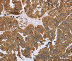 Immunohistochemistry of paraffin-embedded Human ovarian cancer tissue using IKBKE Polyclonal Antibody at dilution 1:30