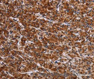 Immunohistochemistry of paraffin-embedded Human prostate cancer tissue using LRRC15 Polyclonal Antibody at dilution 1:60