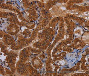 Immunohistochemistry of paraffin-embedded Human thyroid cancer tissue using WDR83 Polyclonal Antibody at dilution 1:60