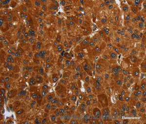 Immunohistochemistry of paraffin-embedded Human liver cancer tissue using ENTPD7 Polyclonal Antibody at dilution 1:40