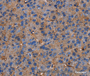 Immunohistochemistry of paraffin-embedded Human liver cancer tissue using NRIP3 Polyclonal Antibody at dilution 1:60