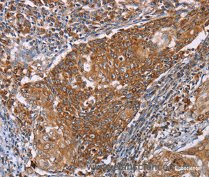 Immunohistochemistry of paraffin-embedded Human cervical cancer tissue using PMPCB Polyclonal Antibody at dilution 1:50