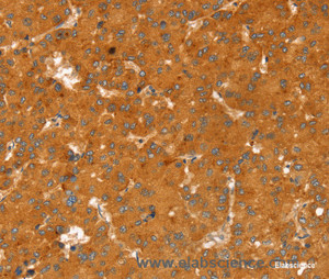 Immunohistochemistry of paraffin-embedded Human liver cancer tissue using RGS4 Polyclonal Antibody at dilution 1:25