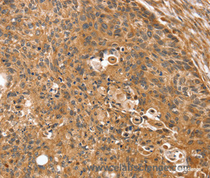 Immunohistochemistry of paraffin-embedded Human esophagus cancer tissue using SSX2IP Polyclonal Antibody at dilution 1:35