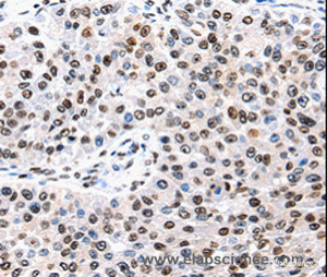 Immunohistochemistry of paraffin-embedded Human renal cancer tissue using AQP2 Polyclonal Antibody at dilution 1:50