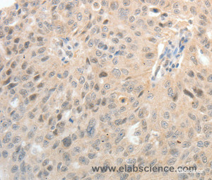 Immunohistochemistry of paraffin-embedded Human ovarian cancer tissue using ASCL1 Polyclonal Antibody at dilution 1:30