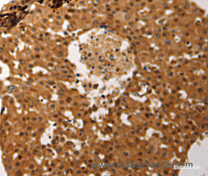 Immunohistochemistry of paraffin-embedded Human ovarian cancer tissue using JUND Polyclonal Antibody at dilution 1:60