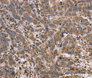 Immunohistochemistry of paraffin-embedded Human liver cancer tissue using EPOR Polyclonal Antibody at dilution 1:40