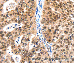 Immunohistochemistry of paraffin-embedded Human ovarian cancer tissue using LRP5 Polyclonal Antibody at dilution 1:115