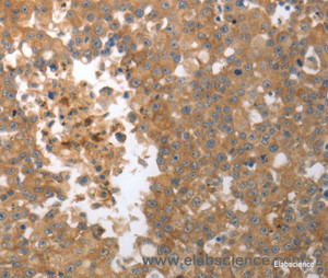 Immunohistochemistry of paraffin-embedded Human breast cancer tissue using MMP27 Polyclonal Antibody at dilution 1:50