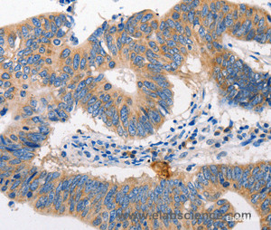 Immunohistochemistry of paraffin-embedded Human colon cancer tissue using MTOR Polyclonal Antibody at dilution 1:60