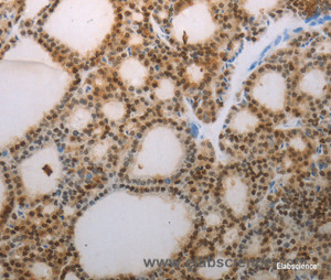 Immunohistochemistry of paraffin-embedded Human thyroid cancer tissue using S100A1 Polyclonal Antibody at dilution 1:70